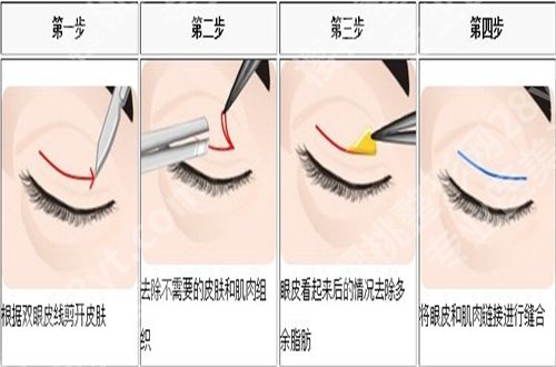 寇静波双眼皮案例一览，分享术前术后的变化