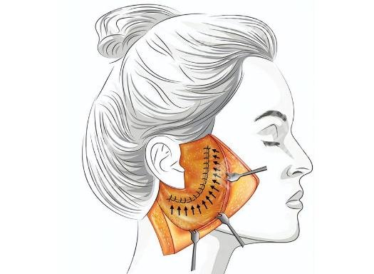 西安画美拉皮咋样？详细介绍、口碑点评、明星项目