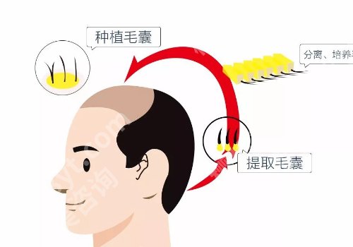 钦州第二人民医院植发多少钱？大概是在7000元起