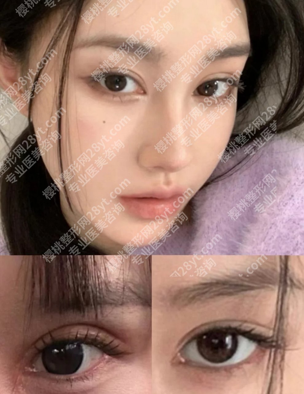 北京黄久佐修复双眼皮什么价位?技术怎么样?风格自然吗?