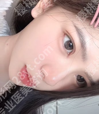 哈尔滨瑞丽整形双眼皮怎么样？真人做眼部手术全流程一览！