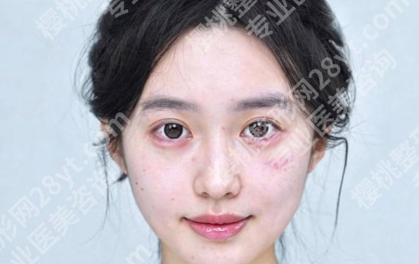 深圳拉皮手术袁强案例曝光！戳进来看真实的口碑点评！