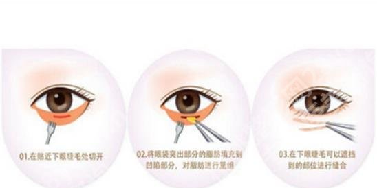 李东医生祛眼袋案例!明星项目和案例鉴赏