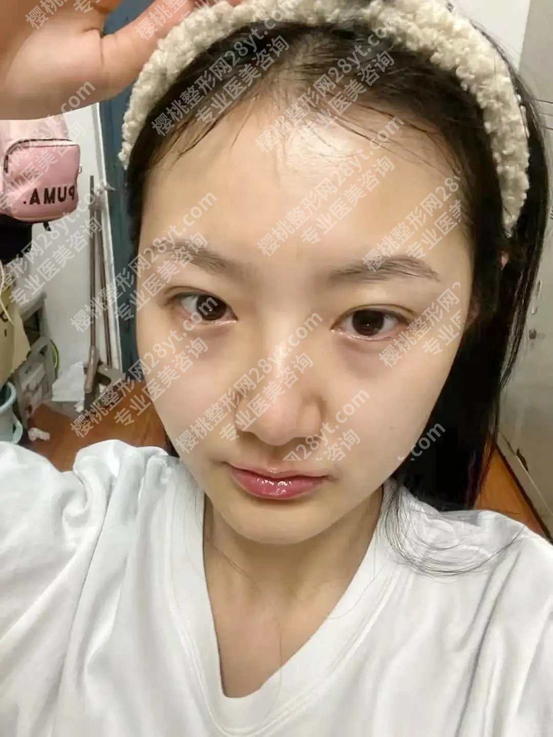 吴乐昊医生眼袋手术怎么样了呀？医生简介网友反馈和擅长项目了解