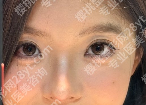 哈尔滨瑞丽做双眼皮好的医生！高峰、鲁文起、宋桂霞等技术风格不同