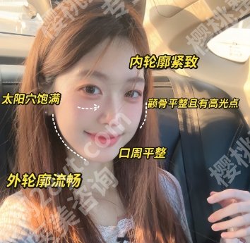 邱立东简介来袭！做颧骨整形手术案例及术前术后小贴士分享！