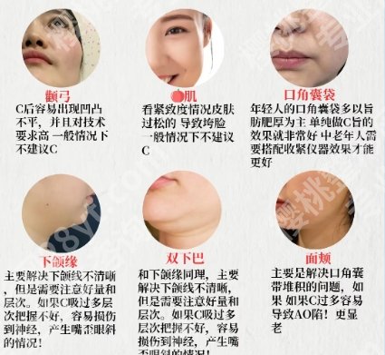 北京张春彦面吸技术好不好？真人案例图展示！来看对比