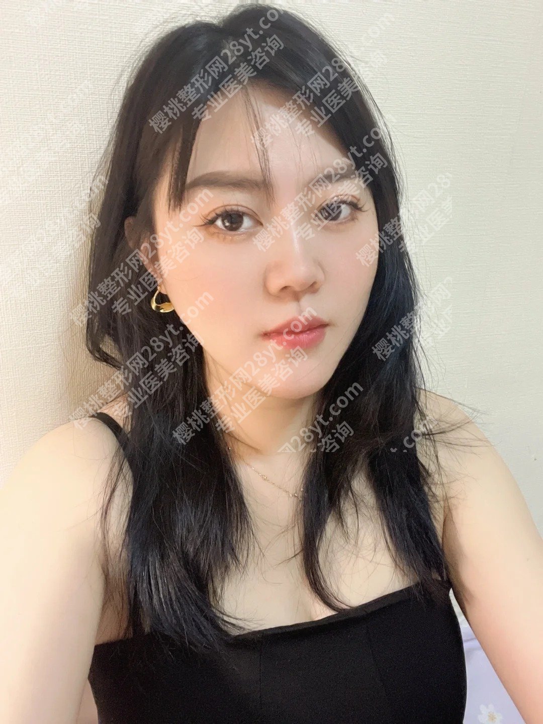 中山大学附属第三医院近视激光手术怎么样?医院亮点、案例展示、2025价格表