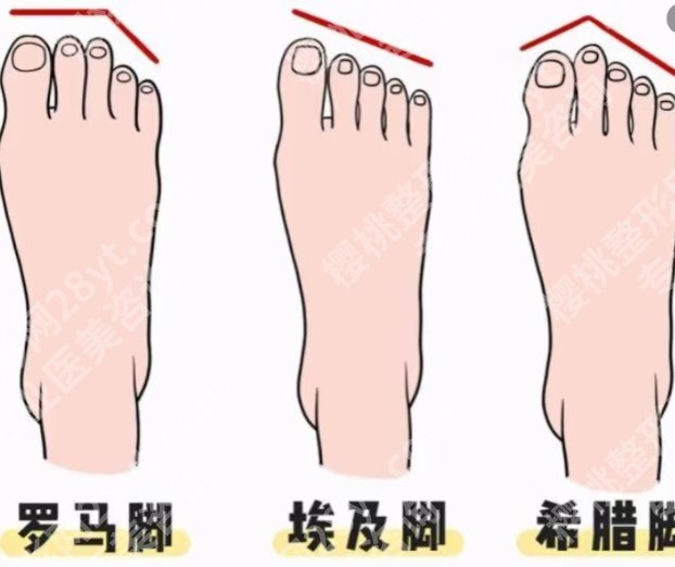 北京苏敬达二脚趾缩短技术靠谱吗?医生口碑测评|真人案例鉴赏!