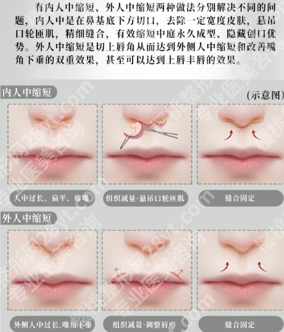 北京潘柏林做人中缩短怎么样？医生技术优势剖析！点进来看详细介绍！