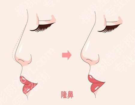 杭州张建文医生鼻子案例怎么样？隆鼻案例详情戳进来看