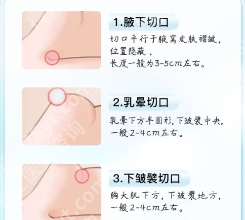 陈育哲隆胸案例图展示！网友亲身经历分享！来看对比！