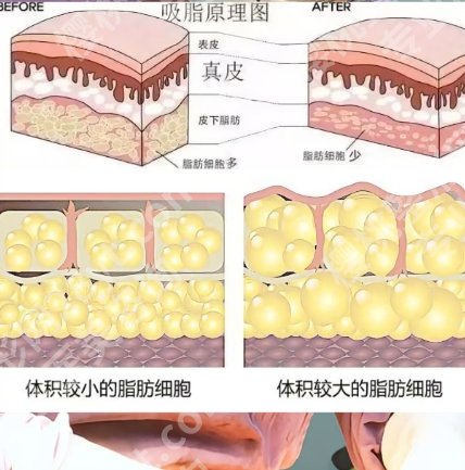 成都怡脂整形医院大腿吸脂案例曝光！手术流程记录