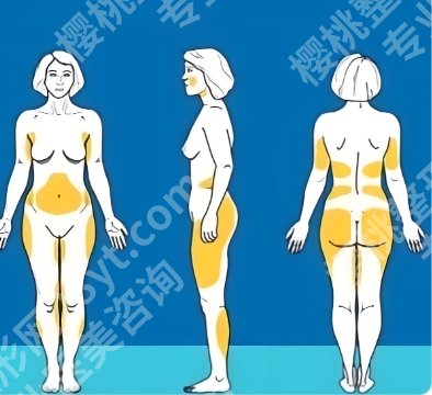 成都怡脂医疗效果怎么样？做吸脂技术如何？案例鉴赏！