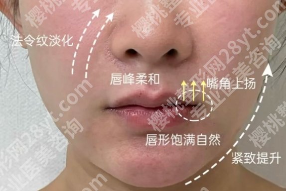 重庆军科李亚栗怎么样?填充手术过程记录!分享给大家做参考