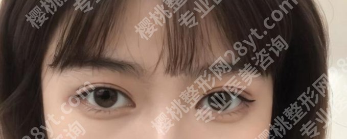 马懿医生双眼皮技术优势是什么？眼部案例图曝光
