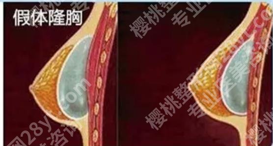 成都美莱熊猛擅长什么？真实的胸部整形案例鉴赏