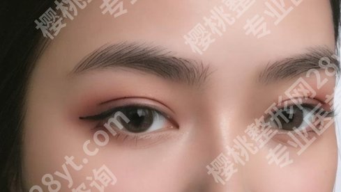 北京眼部整形哪里好？联合丽格、纯脂、美莱等机构口碑不错哦！