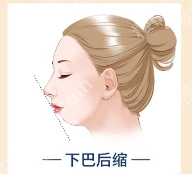 厦门下巴后缩如何矫正？哪家医院好？五家口碑机构展示！