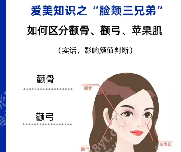 成都赵延峰做颧骨的技术好吗？真实案例分享