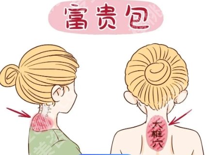 上海九院富贵包手术挂什么科？手术注意事项分享！
