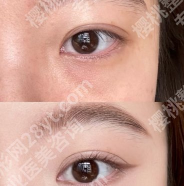 西京医院整形科做眼袋价格贵不贵?热心网友点评及面诊技巧get!