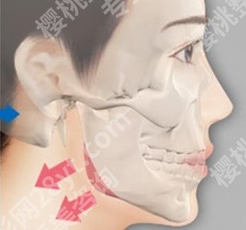 上海九院下颌角手术好的医生是谁？程丽英、俞哲元优势对比！