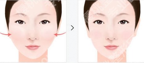 华西可以做颧骨内推吗？医院整形科技术优势分析！