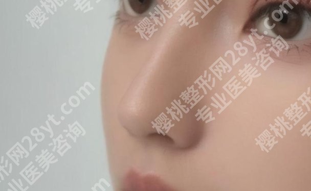 北京301隆鼻经历分享！手术后恢复期阶段性分享！