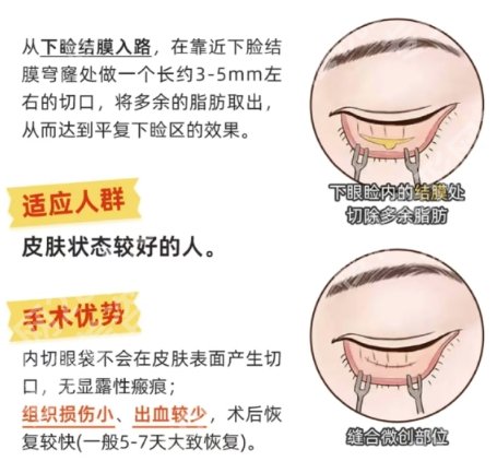 北京协和医院祛眼袋怎么样？医院实力点评|案例展示！