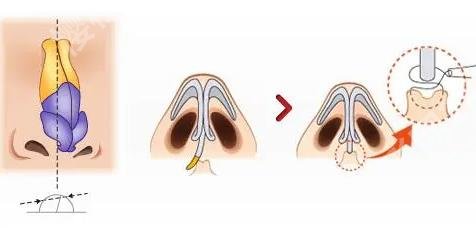 上海九院歪鼻矫正手术大概多少钱?医院核心项目技术优势盘点!