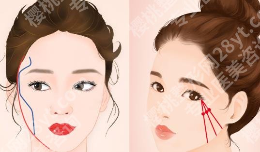 华西医院颧骨内推手术费用多少？戳进来看面诊要点