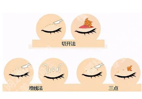 广州武警医院割双眼皮多少钱？低至6200元起！好评如潮！
