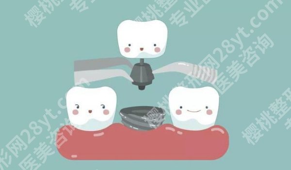 东莞塘厦医院种牙多少钱？价格低至1.6w起！医院亮点一览！