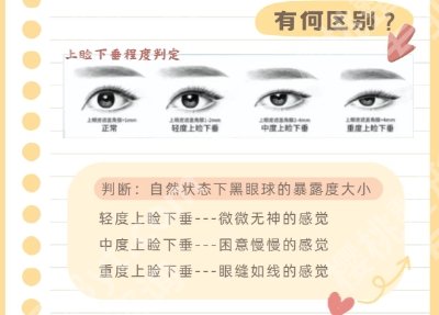西安张卓医生双眼皮怎么样？网友亲身经历展示！