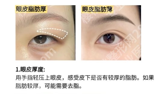 2025海淀医院双眼皮手术费用！全切6000元起！李生、齐一兰技术审美在线