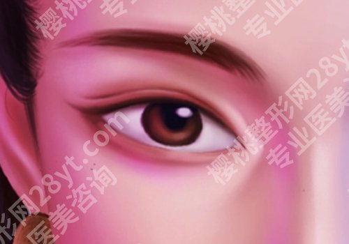 李光琴双眼皮修复案例曝光！广州韩妃实力派代表！技术沉稳！
