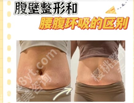 深圳北大医院抽脂怎么样？医院实力测评、吸脂案例图鉴赏！