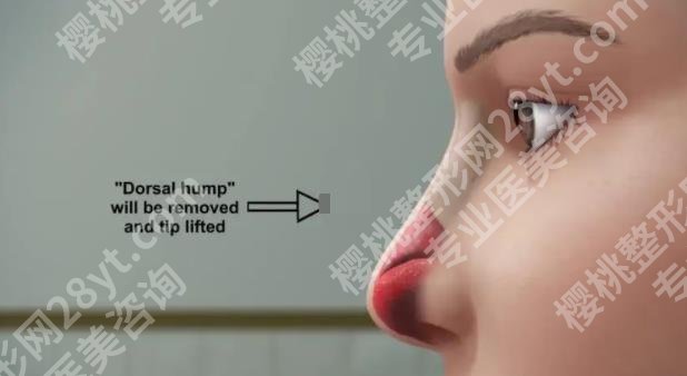 成都华西医院隆鼻假体取出技术如何？真实案例鉴赏