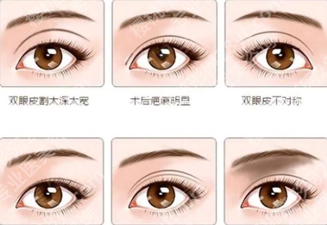 上海九院割双眼皮在哪个院区？苏薇洁vs杨娴娴谁的技术好？