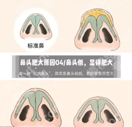 北京八大处鼻翼缩小价格曝光！1.4w元起，赵延勇、杨明勇等性价比挺高