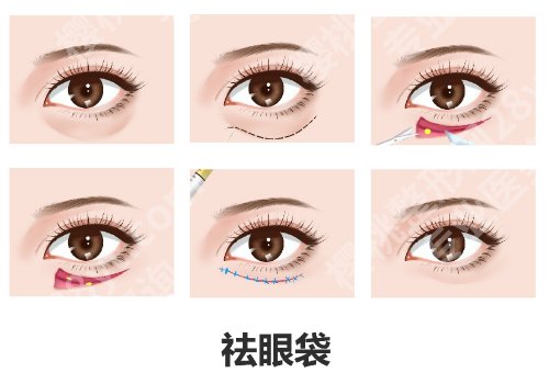 芜湖弋矶山医院美容科割眼袋怎么样？真实案例一览！