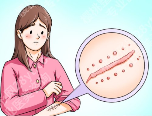 重庆新桥医院疤痕科怎么样？真实案例，见证TA的蜕变！