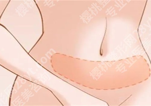 深圳北大医院吸脂多少钱？价格低至1.3w起！收费明细表一览！