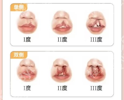 范锴医生做唇裂二次修复怎么样啊？医生口碑测评|价目表一览！