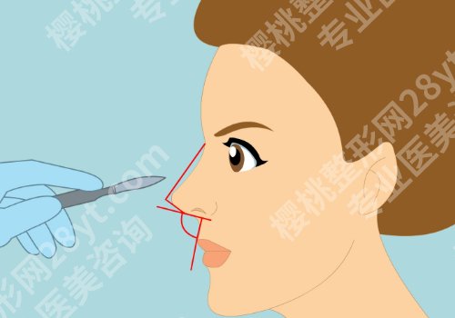 2025广州海峡假体隆鼻多少钱?价格低至1.6w起!你还在等啥?