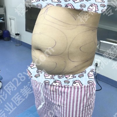 2025广州海峡抽脂价格高吗？低至10000元起！附医院亮点！