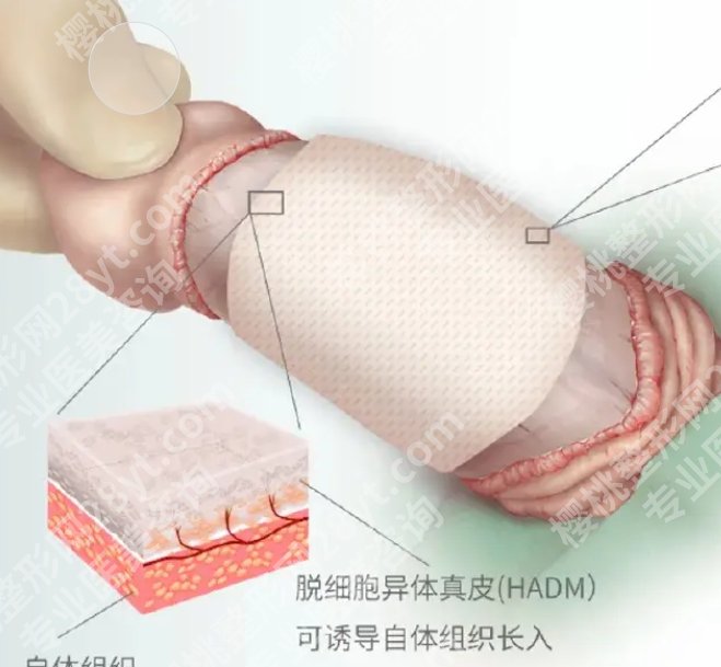 天津男性增粗手术费用多少？各医院收费标准一览！