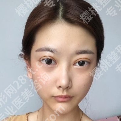 2025广州韩妃割双眼皮多少钱？低至5000元起！特色优势更新！