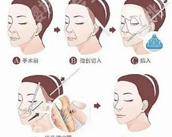 武汉同济医院筋膜悬吊多少钱？曾宁vs王海平实力详解！